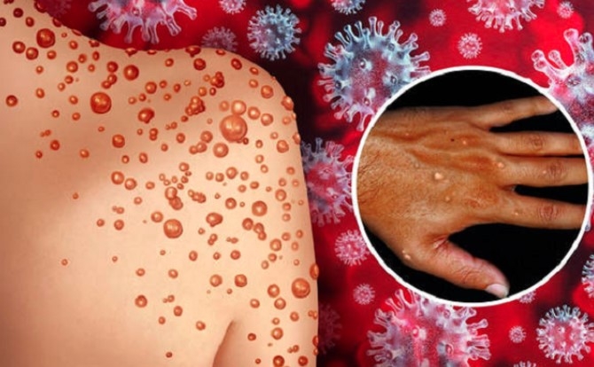 Fifth monkeypox case detected in Ho Chi Minh City